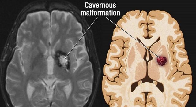 Cerebral Cavernous Malformations