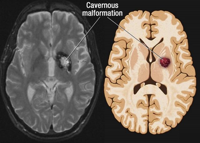 Cerebral Cavernous Malformations