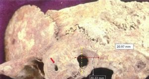 Θάσος: Εντοπίστηκε αρχαίο κρανίο με ίχνη χειρουργικής επέμβασης