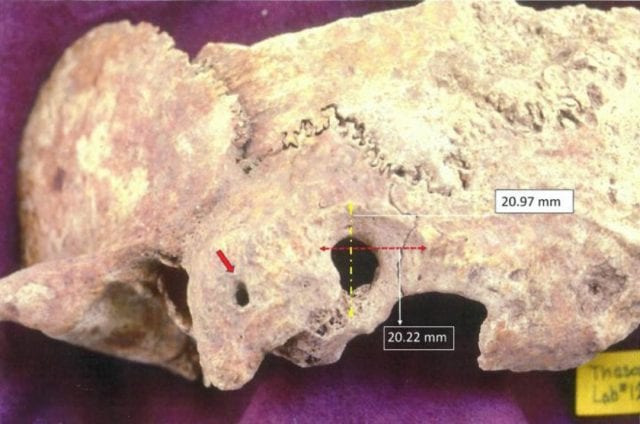 Θάσος: Εντοπίστηκε αρχαίο κρανίο με ίχνη χειρουργικής επέμβασης