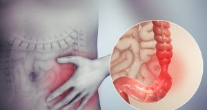 Σύνδρομο Ευερέθιστου Εντέρου (ΣΕΕ) Irritable bowel syndrome