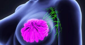 breastcancer7 1025x559 1